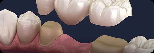 Bridge prenant appui sur des implants