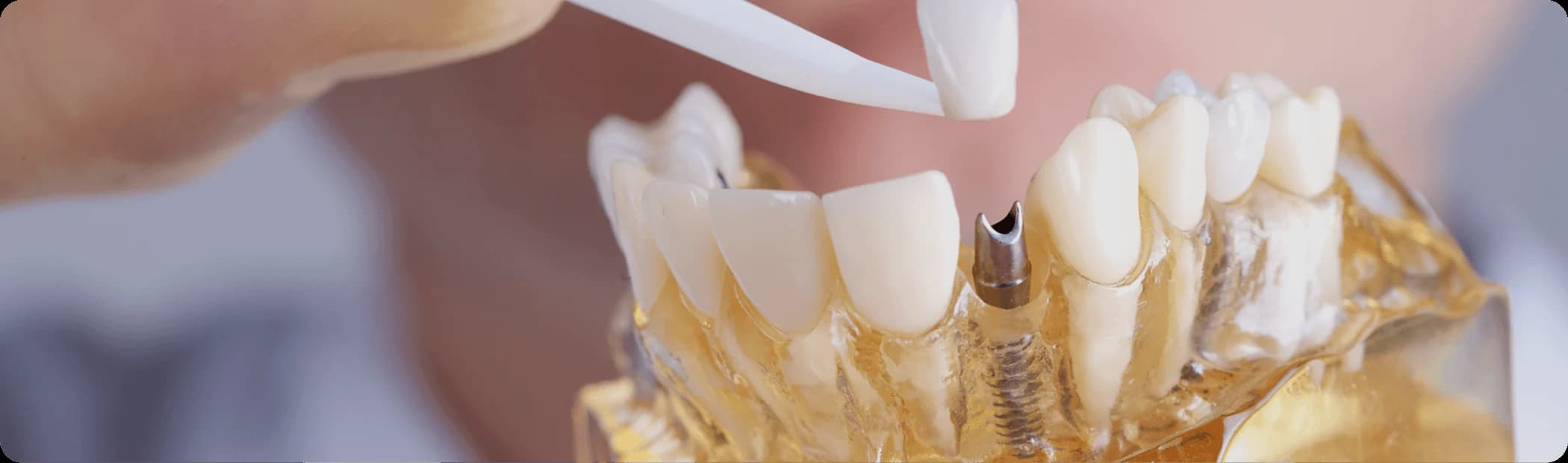 Transparent model showing an implant being placed in the bone