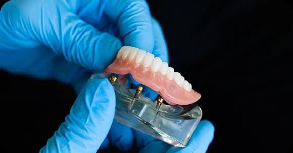 Prothèse complète prenant appui sur des implants