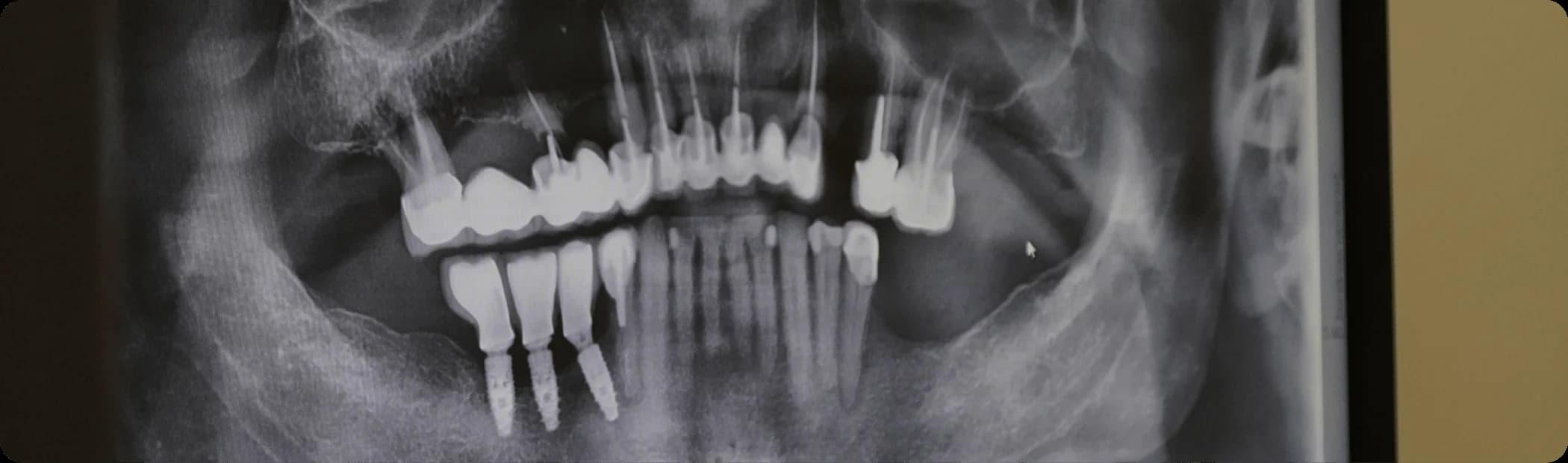 Radiographie panoramique montrant des implants en place dans l’os